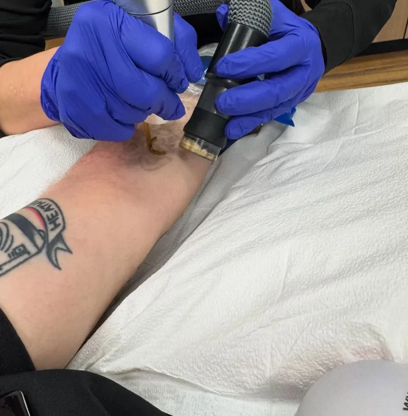 How can I speed up the healing of laser tattoo removal?