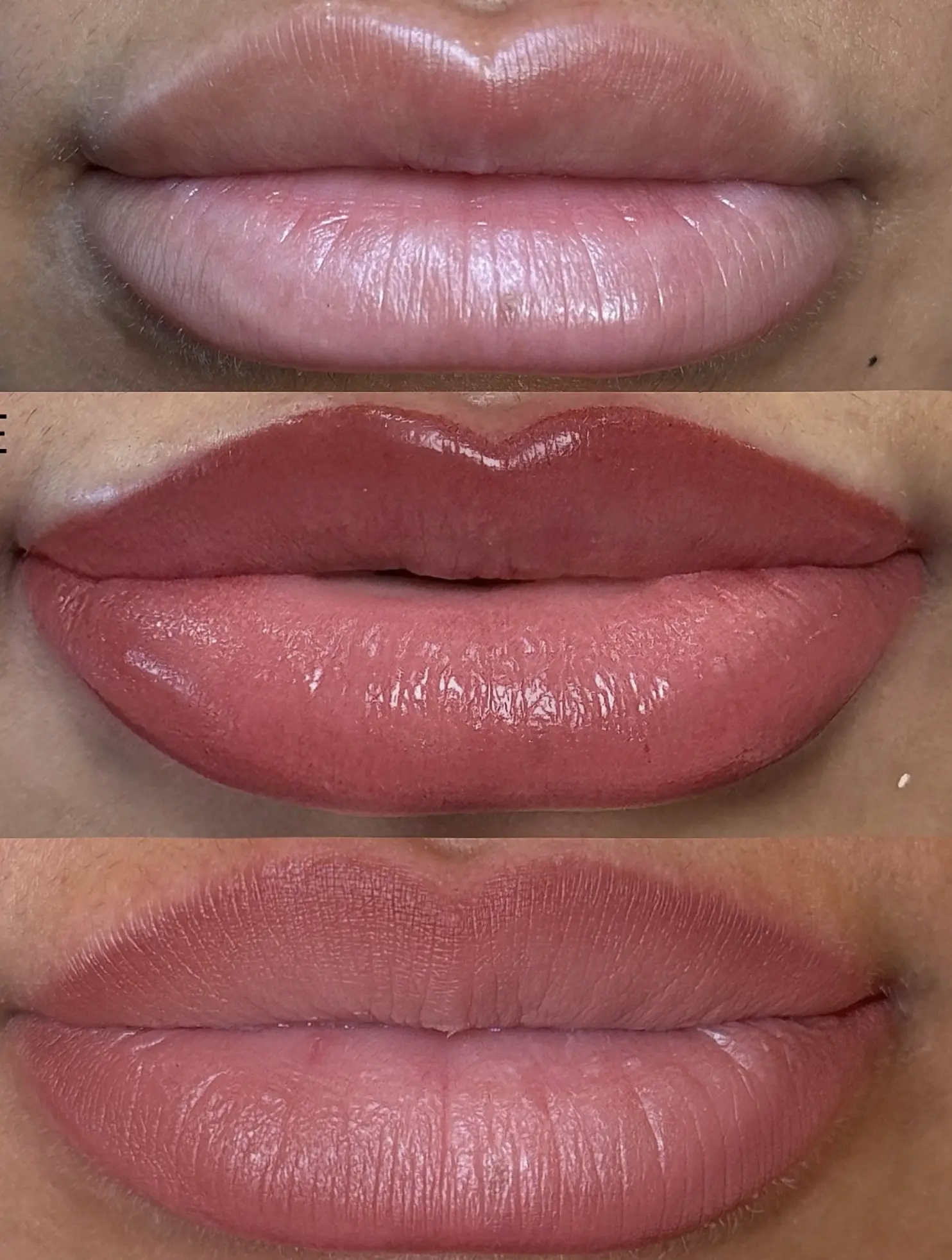 lip neutralization